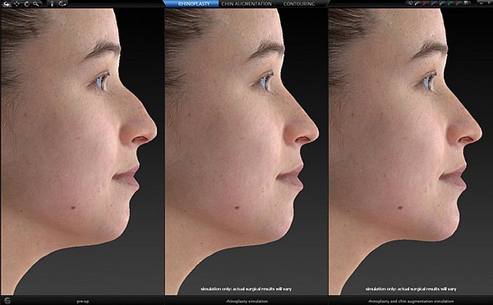 Face Sculptor Nose and Chin Plastic Surgery